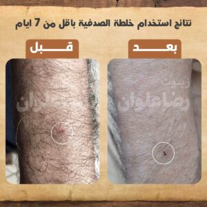 نتائج الصدفية